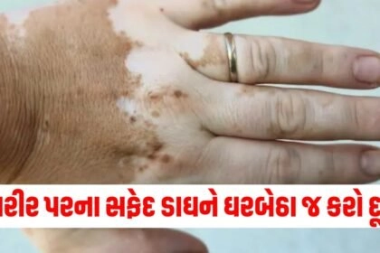 "Vitiligo: Symptoms, causes, and treatments, Vitiligo: Get the Facts on Causes and Treatment, What Causes Vitiligo? 6 Possible Conditions, How To Treat Vitiligo At Home‎, apply these home remedies for Vitiligo disease"