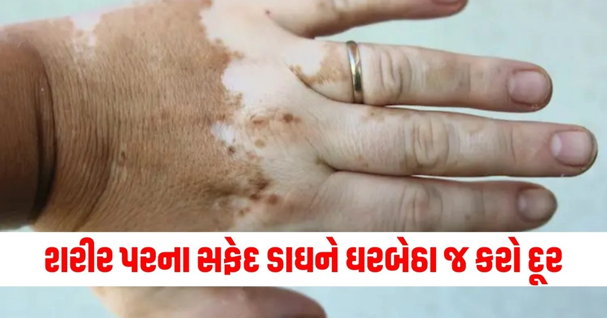 "Vitiligo: Symptoms, causes, and treatments, Vitiligo: Get the Facts on Causes and Treatment, What Causes Vitiligo? 6 Possible Conditions, How To Treat Vitiligo At Home‎, apply these home remedies for Vitiligo disease"