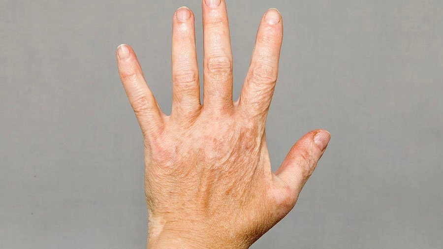 શું તમારા શરીર પર સફેદ ડાઘ છે ? ચિંતા ના કરો એનો ઉપાય ઘરે જ કરો, સાવ સહેલું છે. https://www.pravinews.com/lifestyle/health-fitness/tips-home-remedies-decreasing-vitiligo-aka-white-spots-body-38973