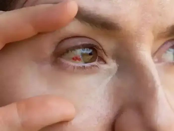 આંખનો આ રોગ કોરોના કરતા પણ ખતરનાક છે, જાણો તેના શરૂઆતના સંકેતો અને નિવારણ https://www.pravinews.com/lifestyle/health-fitness/deadly-eye-infection-marburg-virus-reasons-symptoms-signs-causes-health-news-who-advice-67674