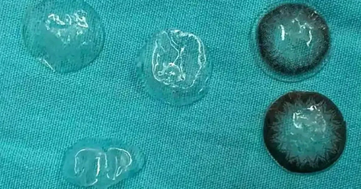 અરે બાપરે... આ શું? ડોક્ટરોને એક મહિલાની આંખ પાછળ ખોવાઈ ગયેલા આટલા બધા કોન્ટેક્ટ લેન્સ મળ્યા https://www.pravinews.com/trending